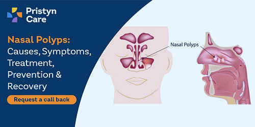 Nasal Polyps: Causes, Symptoms, Treatment, Prevention & Recovery - Pristyn  Care